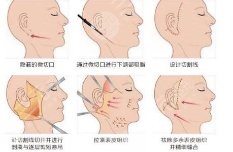 微创小切口除皱术真的那么好吗，降低风险吗