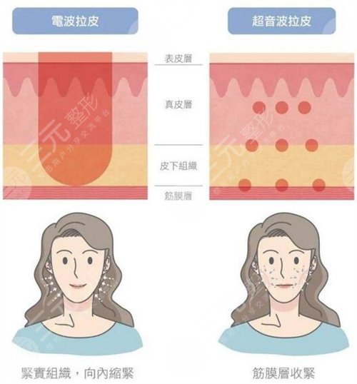 电波l皮除皱果好不好,价格贵不贵了 电波l皮除皱果好不好,价格贵不贵了