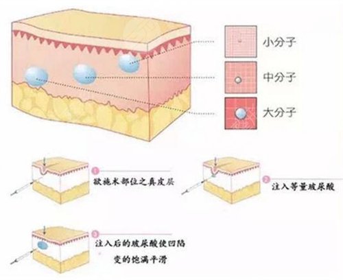 怎么消法令纹,去除法令纹需要多少钱了 怎么消法令纹,去除法令纹需要多少钱了