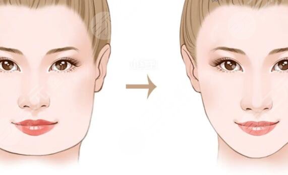 磨骨手术对比照片真实果查看：术后妥妥鹅蛋脸！阳光总在风雨后~