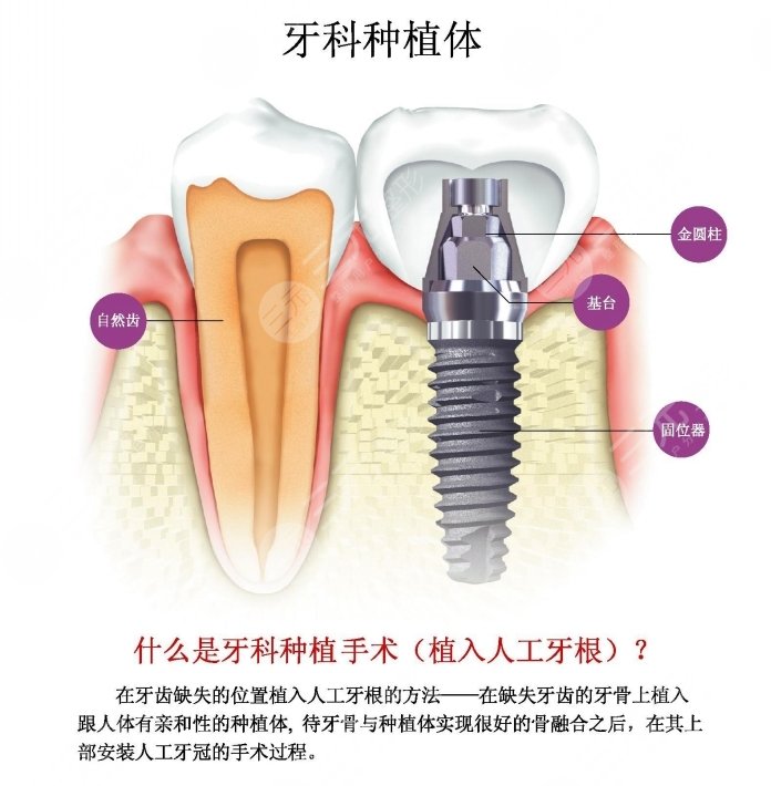 <b>种植牙要多长时间</b>