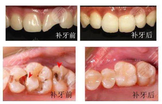 补牙一般要多久 补牙需要多长时间