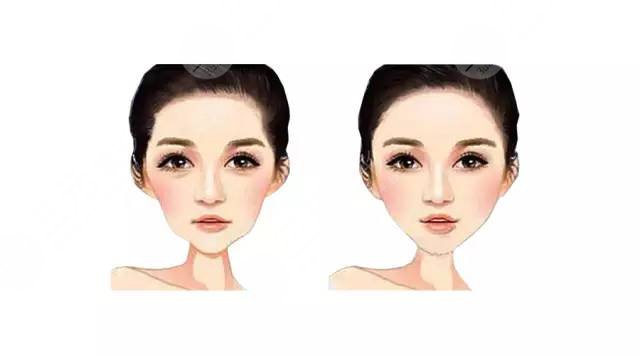 磨颧骨的相关事项