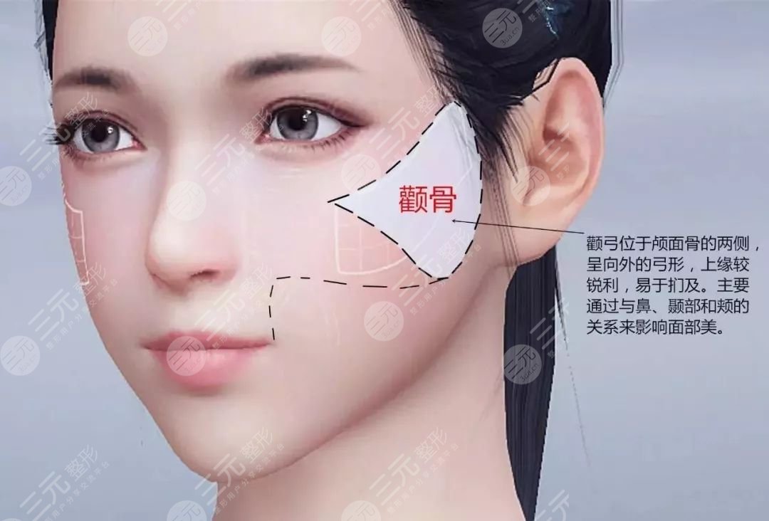 哪些人适合做颧骨缩小术?