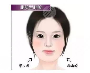 去颊脂垫瘦脸明X吗