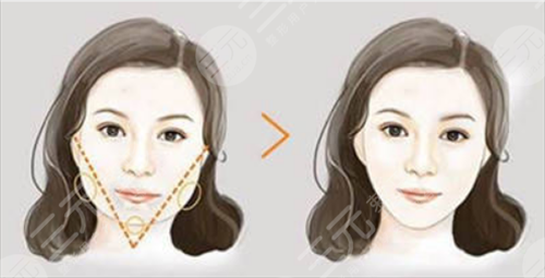 自体脂肪丰苹果肌有什么缺点