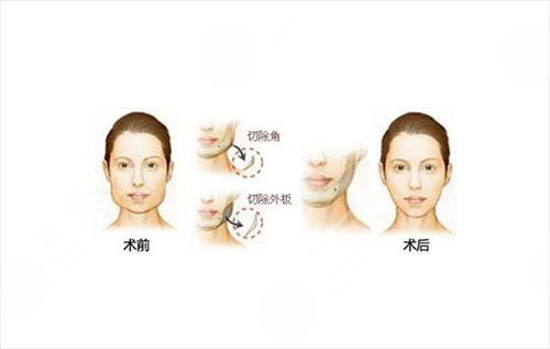 下颌角磨骨整形怎么样