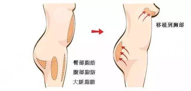 <b>自体脂肪移植隆胸的优缺点</b>