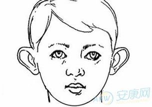 招风耳是否可以缓解