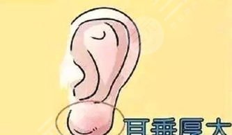 耳垂整形影响听力吗