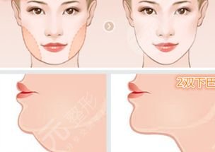 吸脂手术有什么后遗症