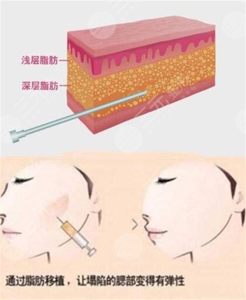 玻尿酸和自体脂肪填充面部凹陷哪个好?优劣势详细对比分析
