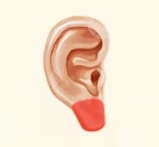 做耳垂整形会影响听力吗