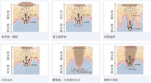 激光去褐青色斑果怎么样、褐青色斑需要激光几次