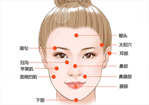 玻尿酸丰面颊不会发炎吗