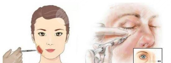 注射瘦脸去川字纹的果怎么样