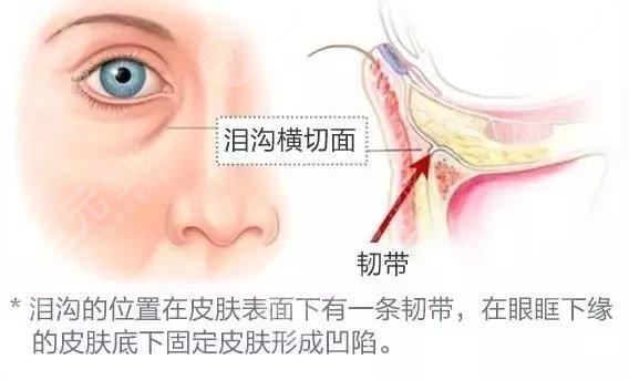 脸上出现泪沟纹怎么办 泪沟纹该怎么去除 脸上出现泪沟纹怎么办 泪沟纹该怎么去除