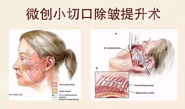 什么是微创小切口除皱 微创小切口除皱的果怎么样 什么是微创小切口除皱 微创小切口除皱的果怎么样