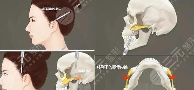 削骨手术的过程是怎样的?