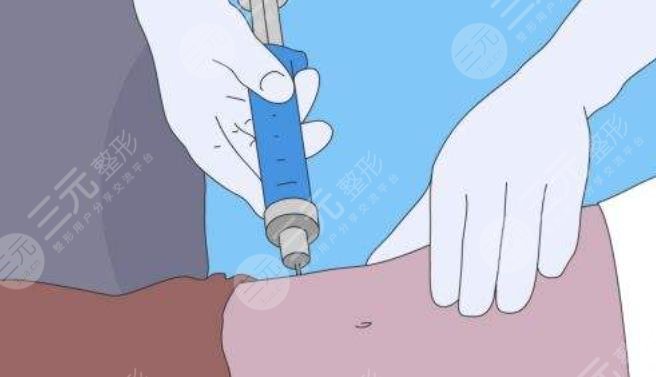 大腿吸脂