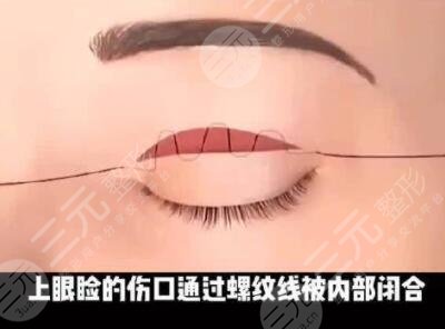 天津武警医院双眼皮案例
