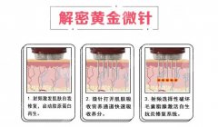 黄金微针为什么好多人做了没果？原理、禁忌症等盘点！术前避雷~