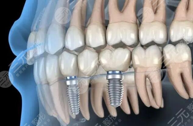 山大一院牙科牙齿种植案例