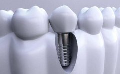 种植牙能用多久？手术原理|优点|注意事项，超全科普助你一口好牙！