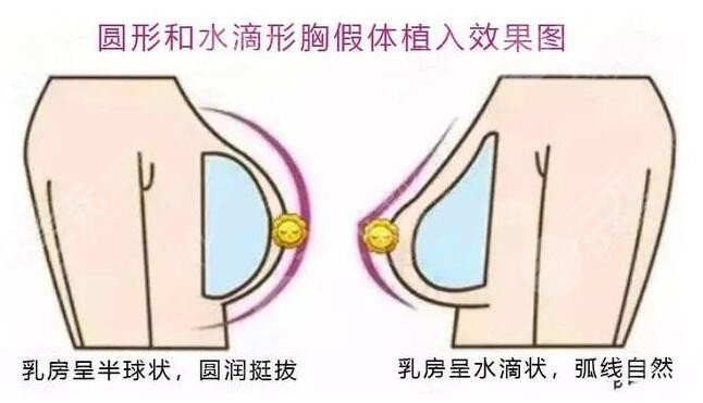 英国娜高假体隆胸型号