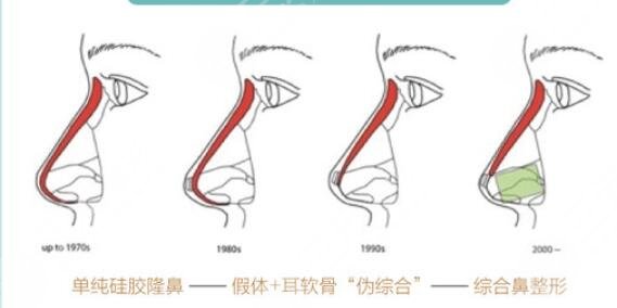 假体隆鼻手术