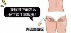 激光祛除臀部坐印果好吗？科普原理|价格|护理事项，白溜光滑谁不爱！