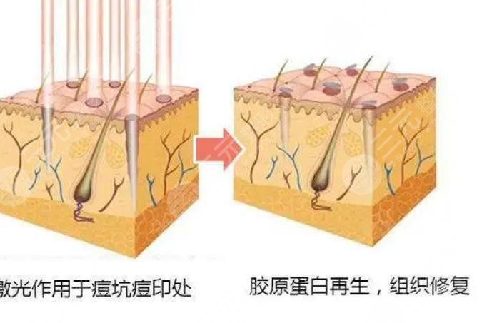 激光祛痘