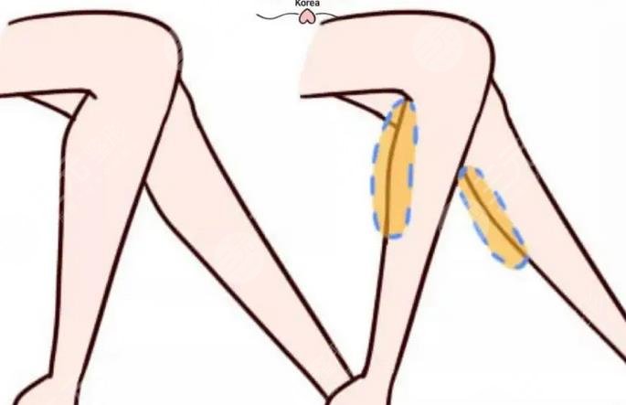 怎么瘦小腿有方法