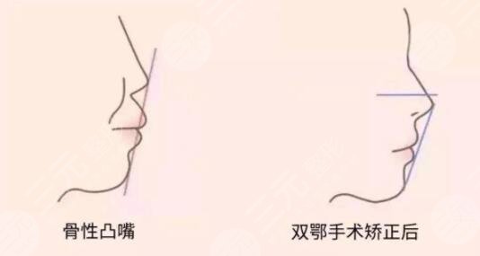 正颌手术住院时间和拆线