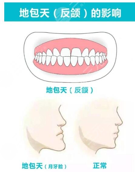 正颌手术术后复查