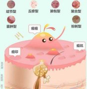 如何去除痘印有？3种不同表现对应方式科普，痘肌小课堂！