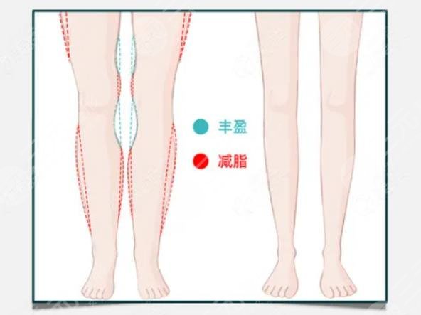 如何预防O型腿?