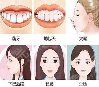 需要正颌的情况