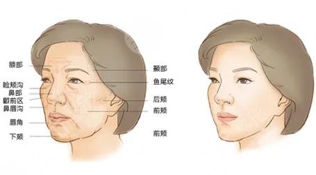 脂肪填充果