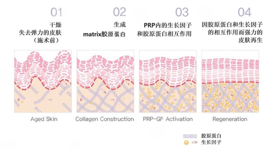 注射胶原蛋白大概能够维持多久?