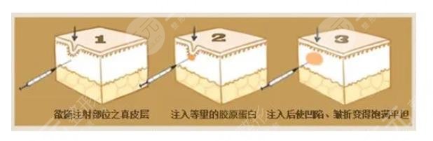 胶原蛋白注射之后需要注意什么?