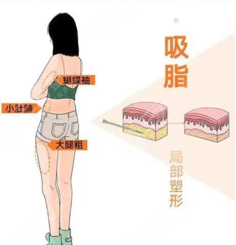 上海吸脂减肥多少钱一次?