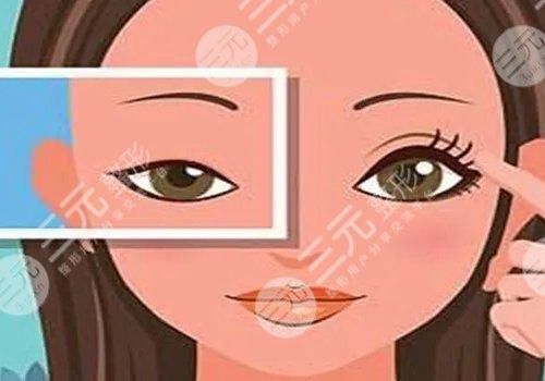双眼皮埋线需要几天恢复?注意什么事项?美眼速成指南~