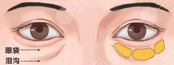 超声波去眼袋