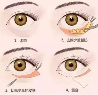 超声波去眼袋原理