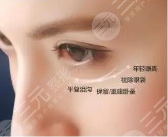 超声波去眼袋优势