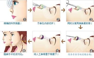 隆鼻手术