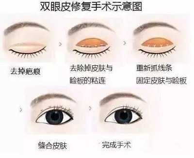 重庆王量医生双眼皮修复案例分享