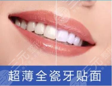 牙齿贴面