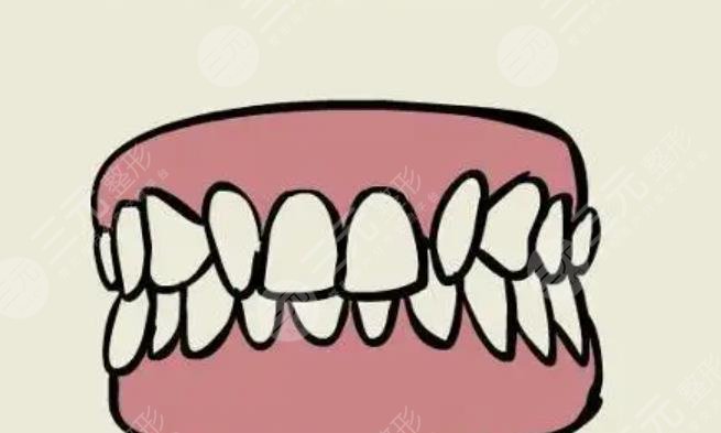 地包天牙齿矫正